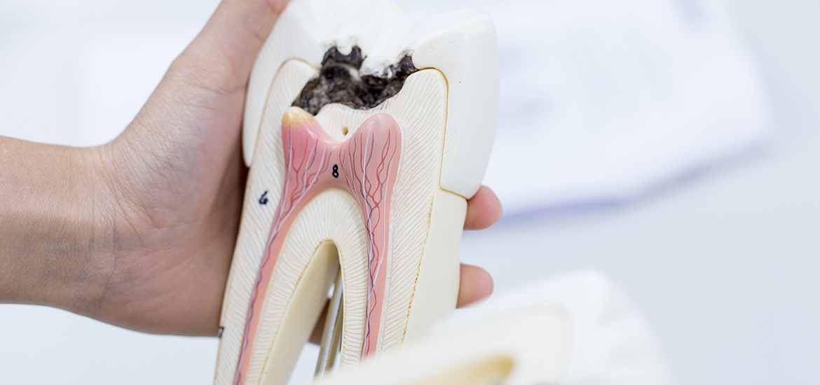 Hochheim: kranken Zahn mit Wurzelbehandlung erhalten